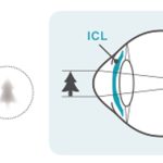 近視の状態とICL治療後の状態