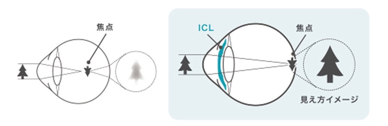 近視の状態とICL治療後の状態