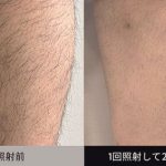 濃い毛にも対応！頼りになります！