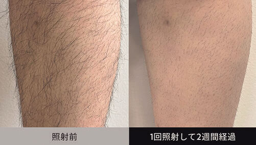 濃い毛にも対応！頼りになります！