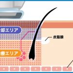 「ミラドライ」の仕組み