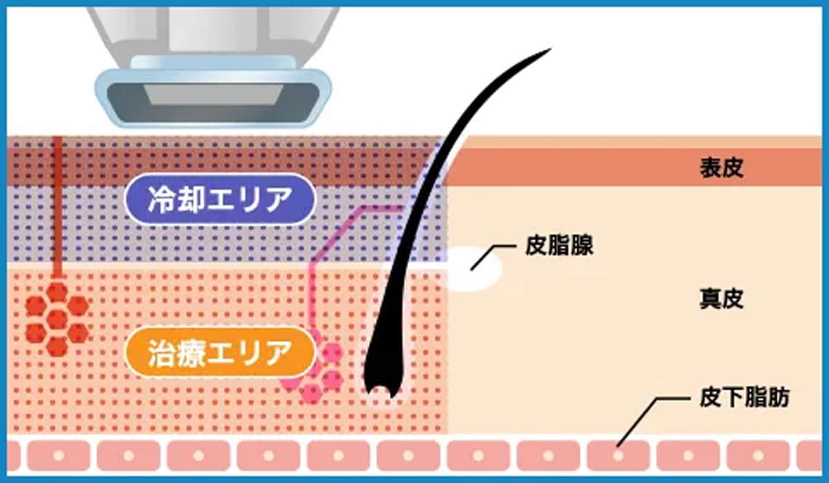 「ミラドライ」の仕組み
