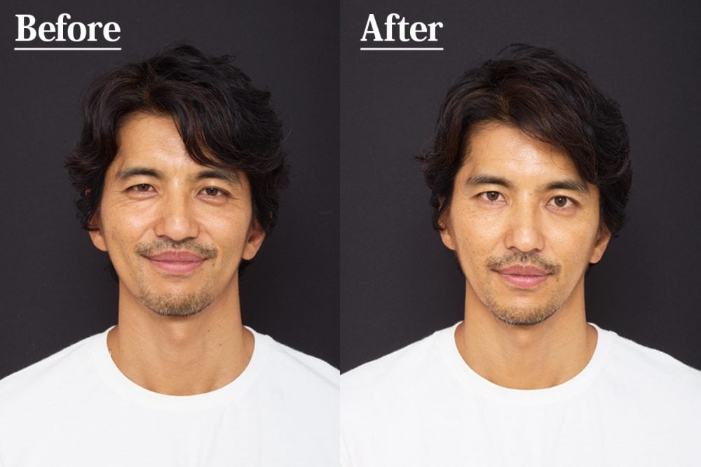 フェイスラインが劇的変化！衝撃のBefore→After