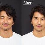 フェイスラインが劇的変化！衝撃のBefore→After