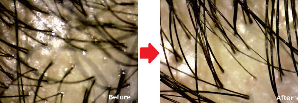 施術前後に頭皮の状態をマイクロスコープでチェック。施術後は、寝ていた髪がしっかり立ち上がっているのがわかる
